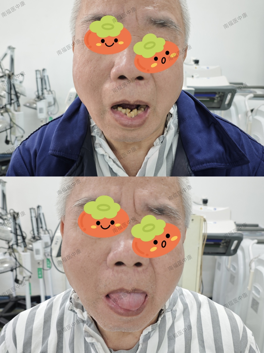 中医针灸精准施治 巧解脑梗后遗症“中风”之苦