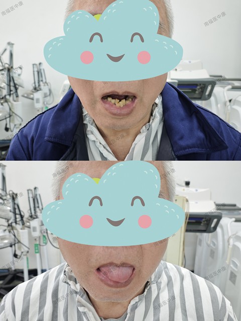 中医针灸精准施治 巧解脑梗后遗症“中风”之苦